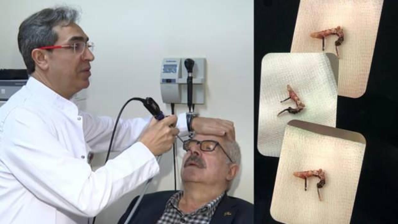 30 yıldır yaşadığı sıkıntının kaynağı burnuna kaçan küpeymiş