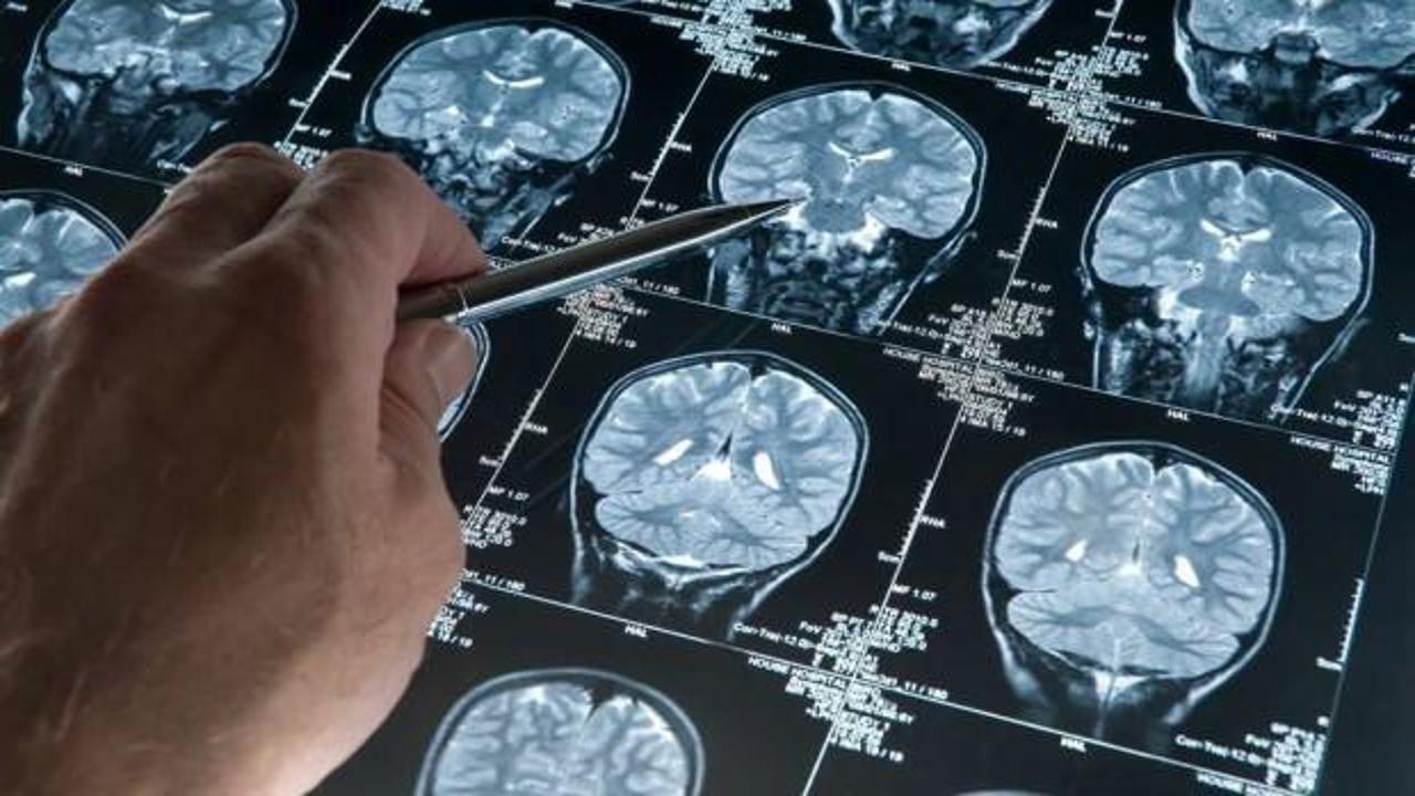 ABD'de bir ilk: Alzheimer ilacına tam onay çıktı!