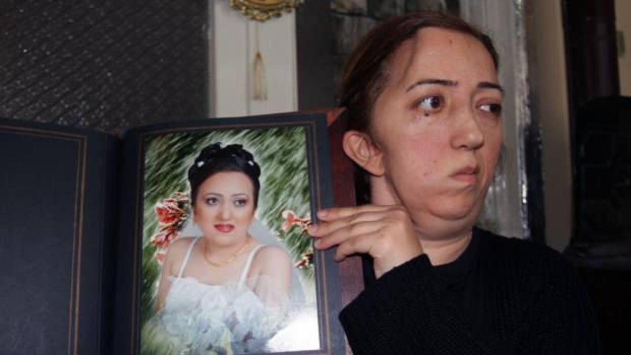 Ameliyat sonrası yüz felci geçiren hemşire hukuk mücadelesi veriyor