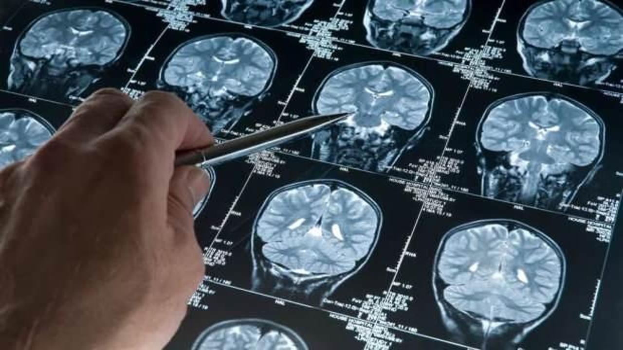 Amerikalı nörolog uyardı: 2 dakikalık test ile bunamanın gizli belirtileri ortaya çıkıyor!