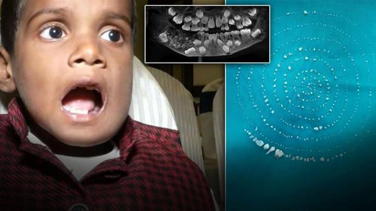 Çocuğun ağzından 526 diş çıkarıldı