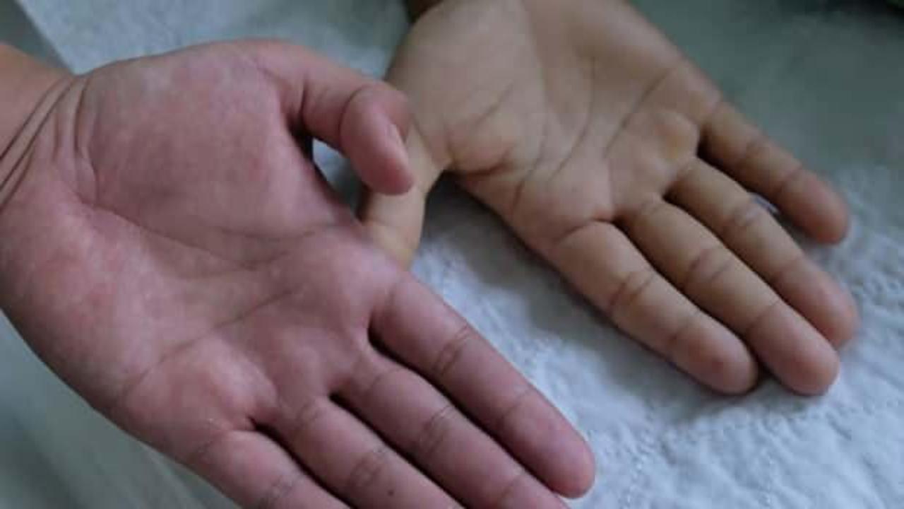 Çok nadir görülüyor! Milyon nüfusta 2 veya 4 kişide rastlanıyor…