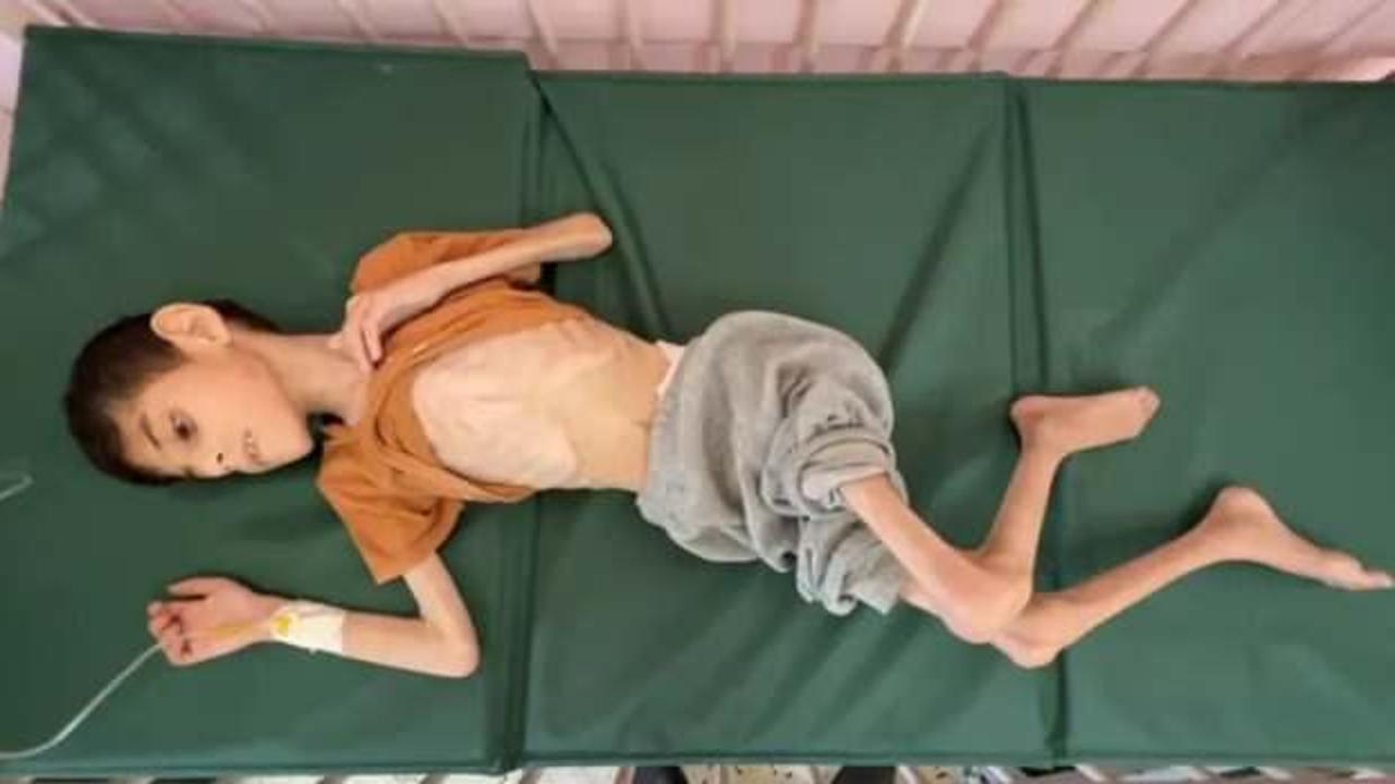Gazze'de çocuklar kirli ve yetersiz su nedeniyle hastalanıyor