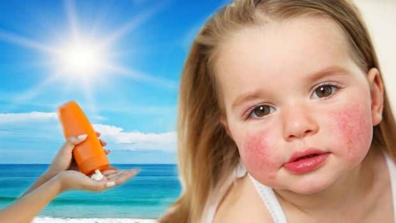 Güneş alerjisine ne iyi gelir, nasıl geçer? Güneş alerjisi belirtileri…