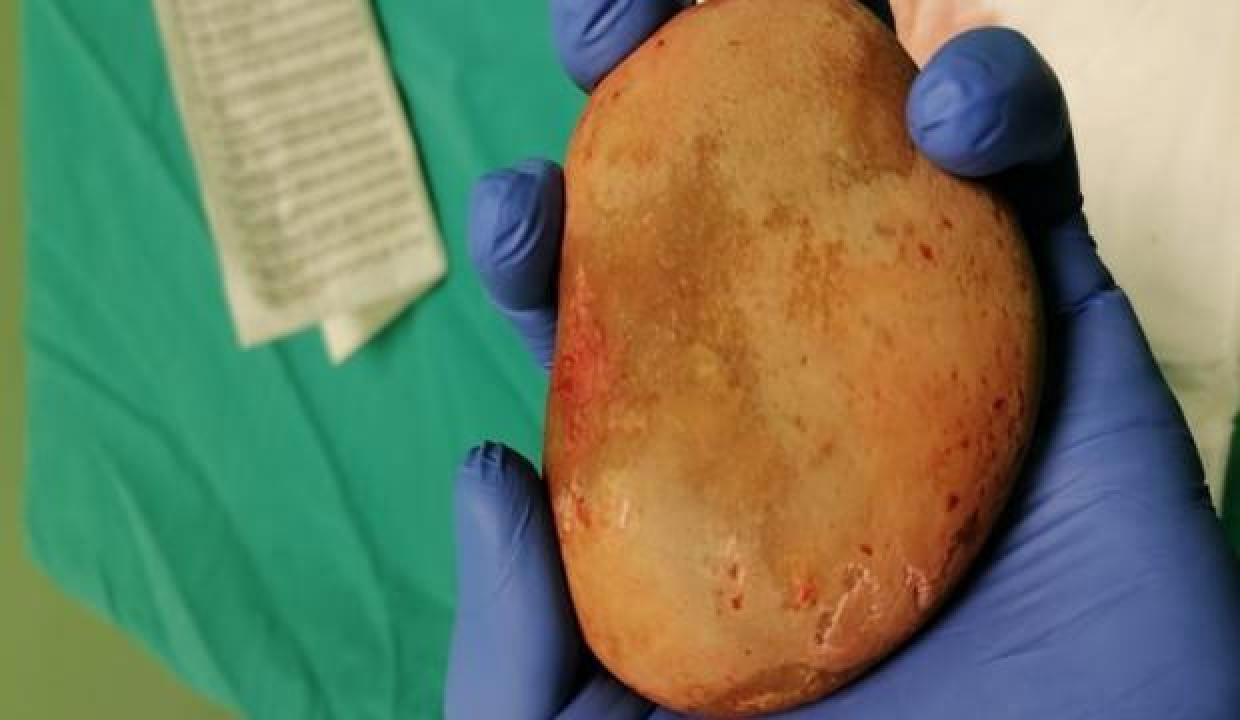 Hastanın mesanesinden çıkan taş doktorları şaşırttı