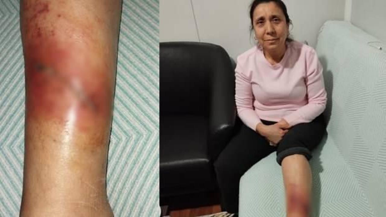 Hatay'da köpek saldırısına uğrayan kadının bacağında yarık oluştu