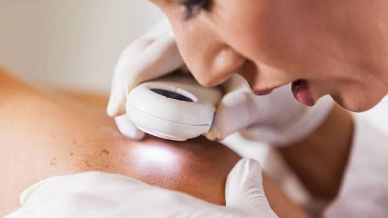 İngiltere'de cilt kanseri vakaları yılda 17 bin 500'e çıktı