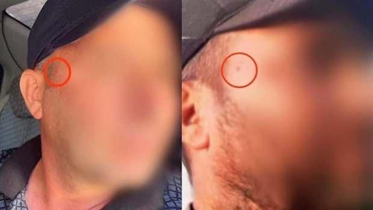 Jandarma korkusundan yüzündeki beni aldırdı