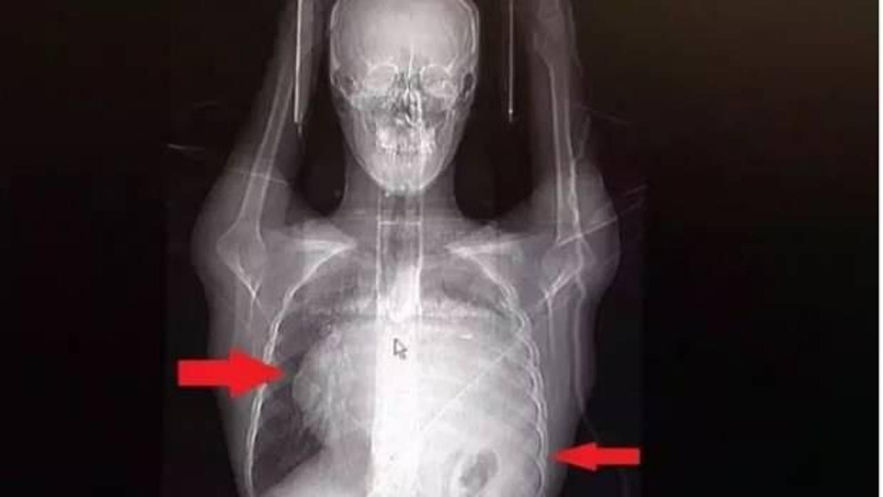Kalbi 12 cm kaydı! Doktorlar bile şaşkın! İstanbul'da müdahale edildi