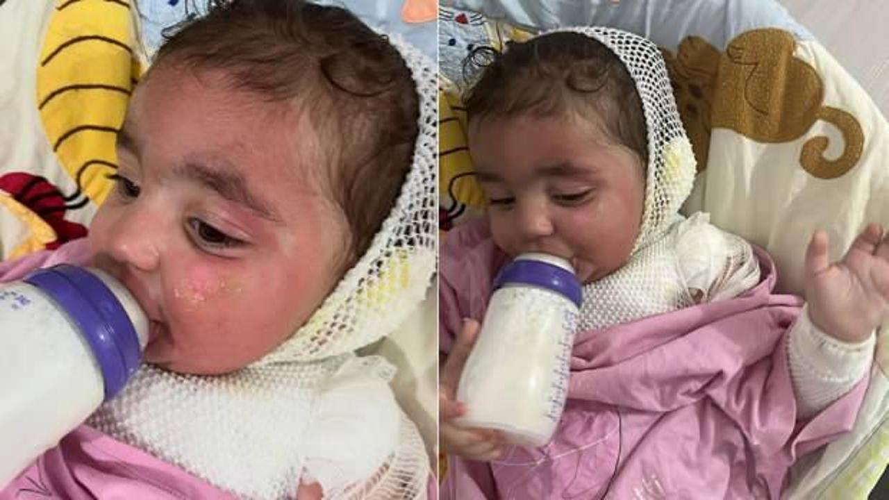 Kreşte çocuğun üzerine kahve döküldü. 2'nci dereceden yanıklar oluştu