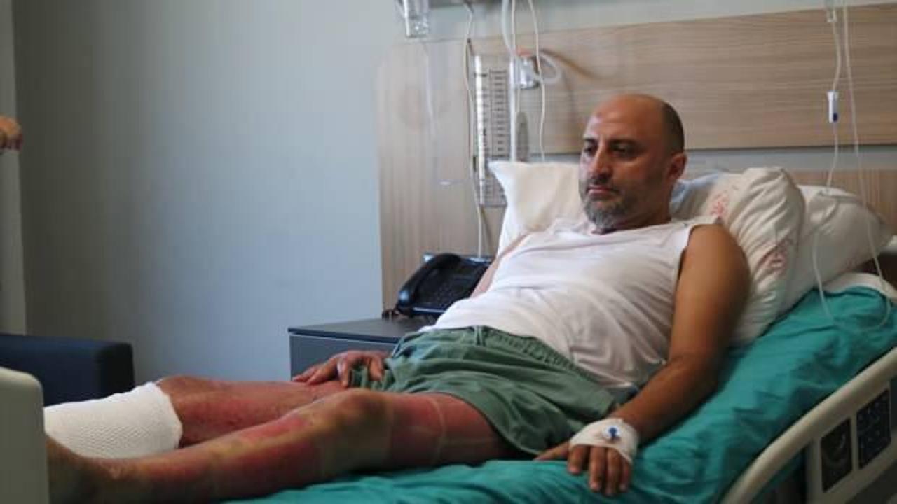 Mangal jeli nedeniyle vücudunun yüzde 38'i yanan hasta su dolu varile atlayarak kurtulmuş