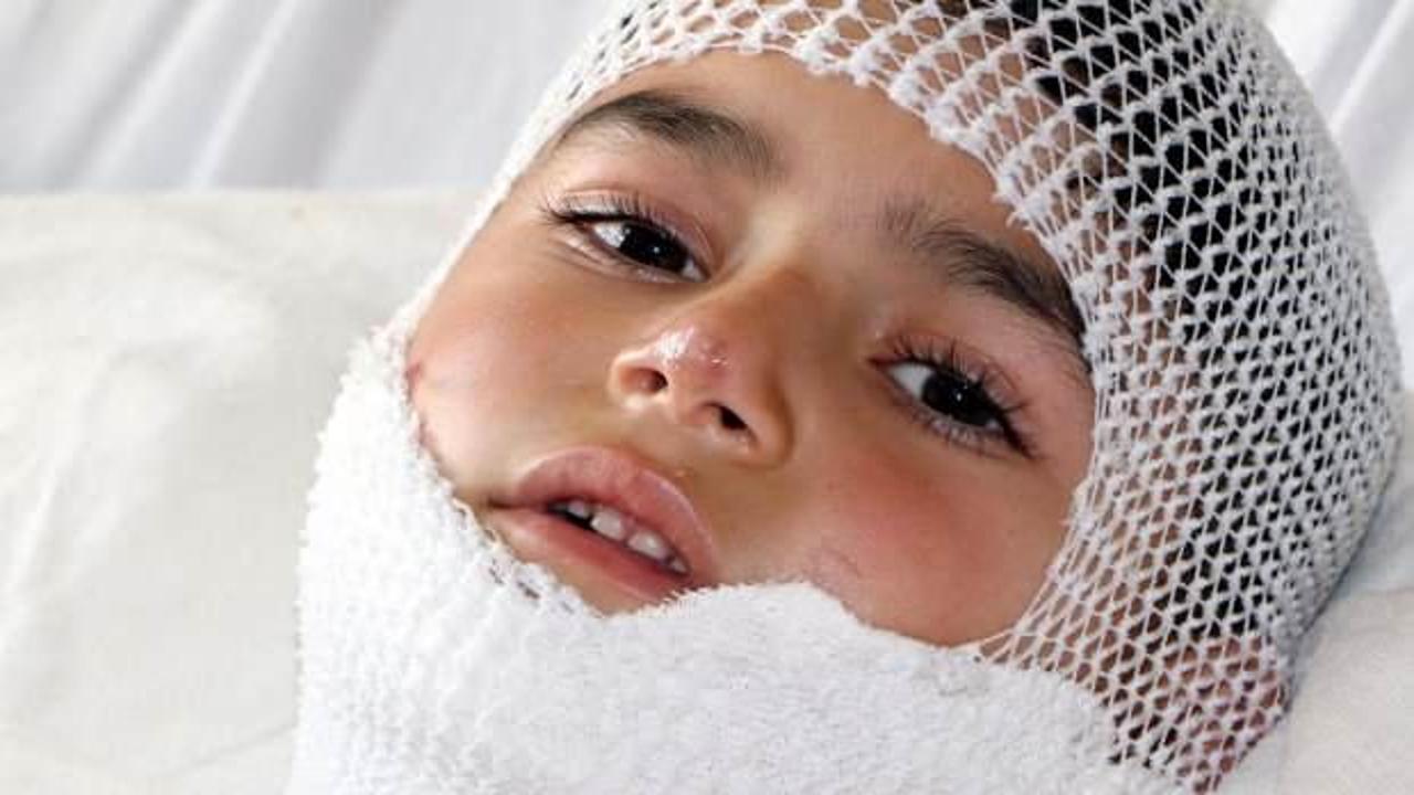 Nahçıvan'da pilav kazanına düştü, Erzurum'da tedavi görüyor