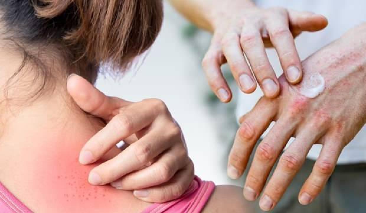 Uzmanı açıkladı! Kaşıntı ve kızarıklıkla ortaya çıkan egzamaya dikkat