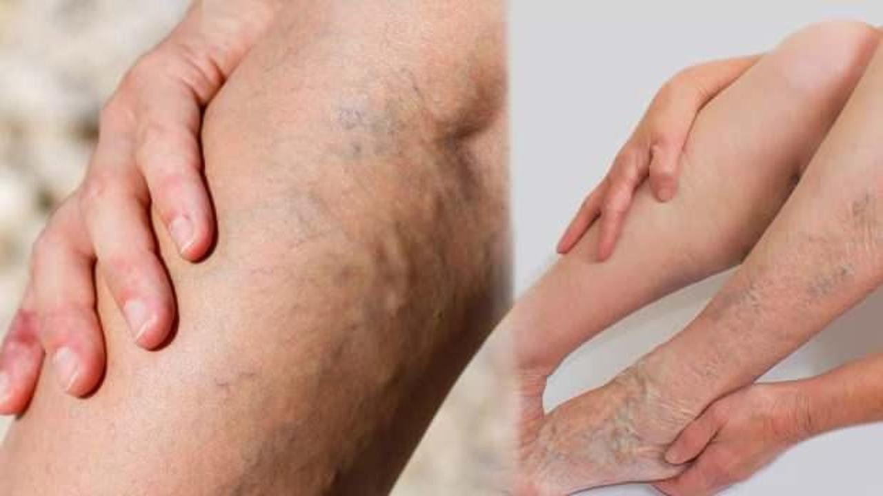 Varis nedir, neden olur? Genç yaşta ve bacakta varis belirtileri…