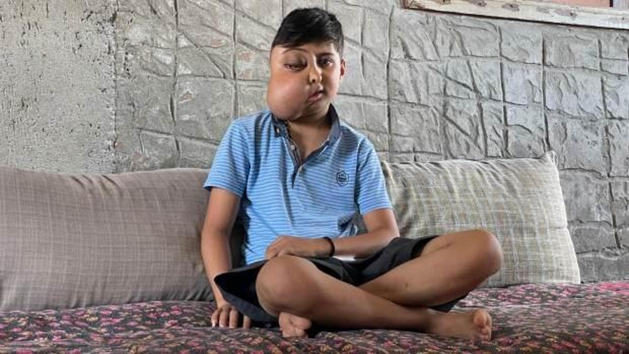 Yüzündeki kitle her geçen gün büyüyor! Gözünü kaybeden Enes’in tek isteği var
